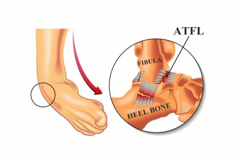Best ATFL/ CFL Ligament Injury in Gurugram