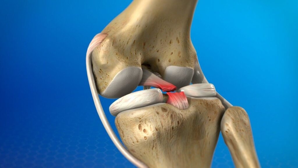 Best PCL Tear Treatment in Gurugram Sector 43
