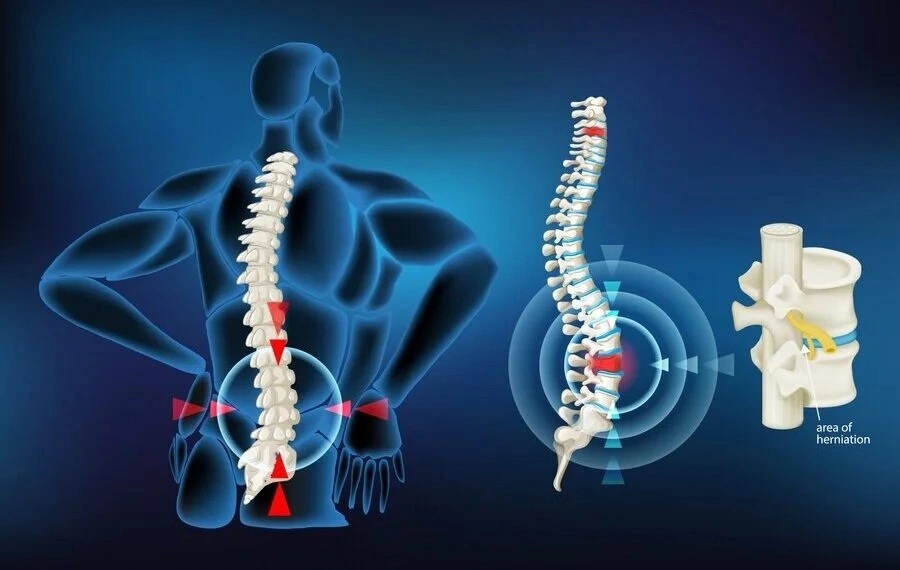 Slip Disc Treatment in Gurgaon Sector 51